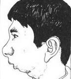 顳下頜關(guān)節(jié)強(qiáng)直 顳下頜關(guān)節(jié)強(qiáng)直