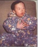 先天愚型