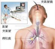 呼吸道異物
