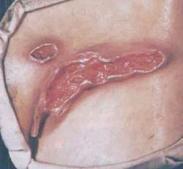 化膿性汗腺炎