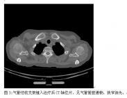 氣管、支氣管狹窄