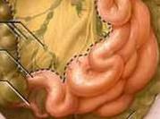急性腸系膜淋巴結炎 急性腸系膜淋巴結炎