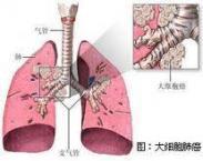 郎-奧韋綜合征
