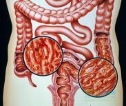 潰瘍性結腸炎性關節炎