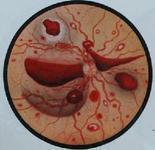 結(jié)締組織性腸炎 結(jié)締組織性腸炎