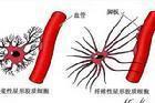 單克隆丙種球蛋白病伴周圍神經(jīng)病 單克隆丙種球蛋白病伴周圍神經(jīng)病