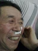 一氧化碳中毒后遲發性腦病 一氧化碳中毒后遲發性腦病