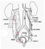輸尿管結(jié)石 輸尿管結(jié)石