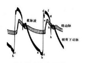 室性早搏 室性早搏