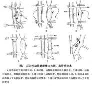 動靜脈瘺 動靜脈瘺