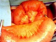 膀胱腫瘤