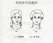 小兒單純性甲狀腺腫 小兒單純性甲狀腺腫