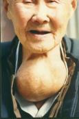 散發性甲狀腺腫