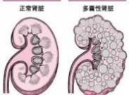 繼發(fā)性腎臟疾病 繼發(fā)性腎臟疾病