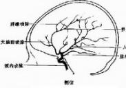 外傷后頸內(nèi)動脈閉塞 外傷后頸內(nèi)動脈閉塞