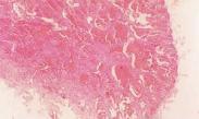 先天性腫瘤
