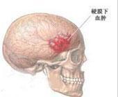 頭皮血腫 頭皮血腫