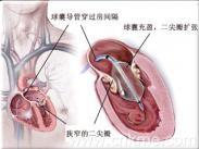 老年人鈣化性瓣膜病 老年人鈣化性瓣膜病